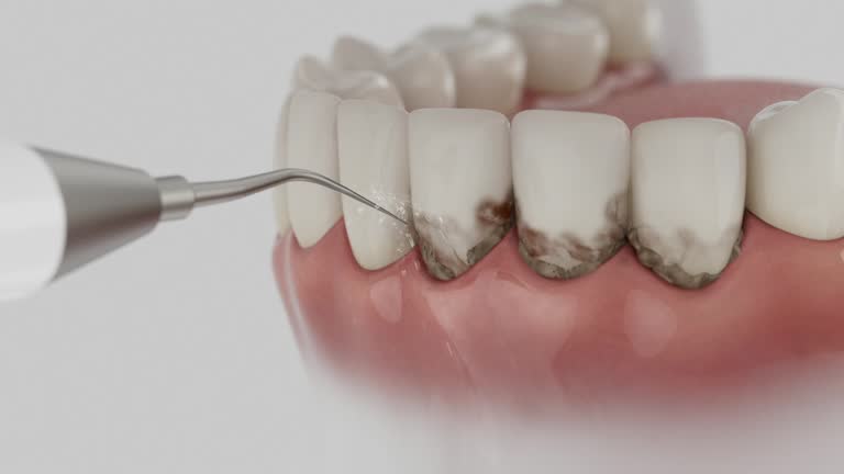 Trusted Teeth Cleaning And Checkup service in Dent, OH - Dentist Open Now